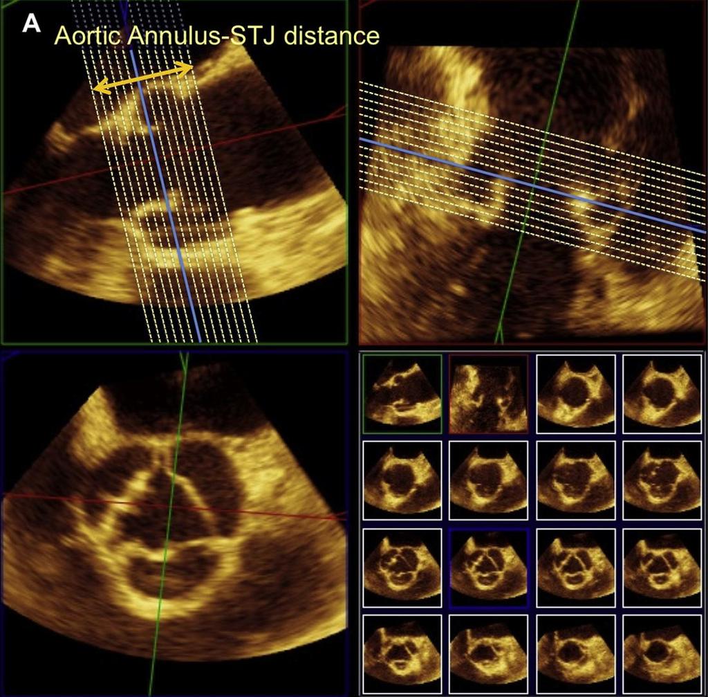 3D Echo of the aortic