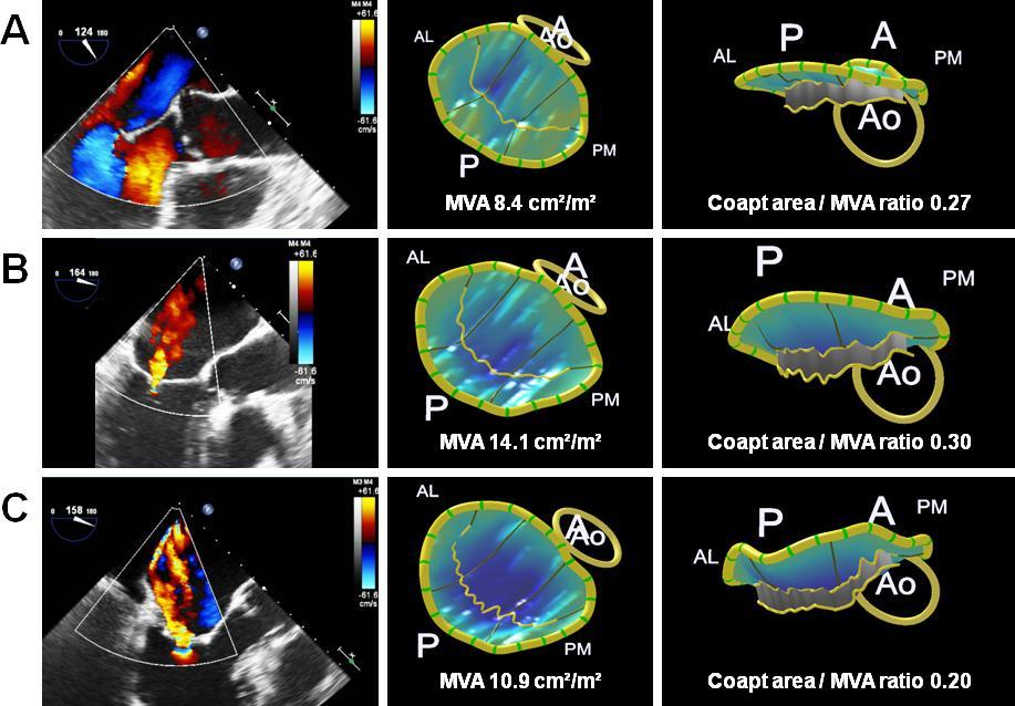 3D Echo of mitral valve Pathophysiology of FMR Functional Mitral Regurgitation post