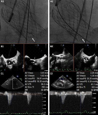 Interventional Echocardiography in TAVR