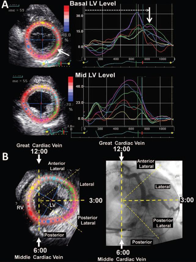 Echocardiography-Guided CRT Echocardiography-Guided Left Ventricular Lead Placement Results of the Speckle Tracking