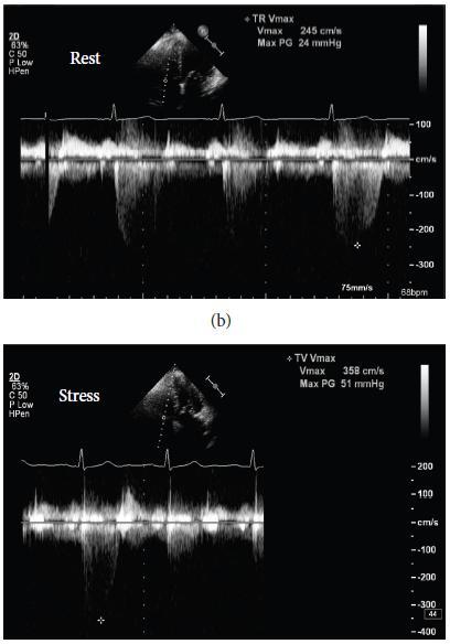 Stress Echocardiography for risk stratification in valvular heart desease In
