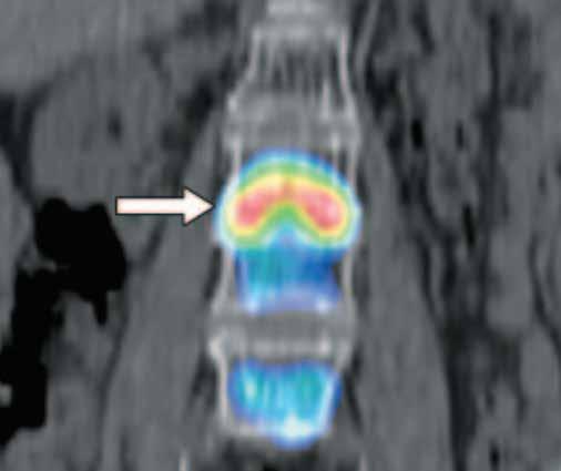 Added value of SPECT/CT fusion in assessing suspected bone