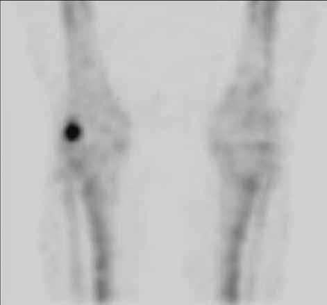 YOUNG MAN WITH LEFT KNEE PAIN PLANAR + SPECT TENTATIVE DX OF TUMOR-LIKE