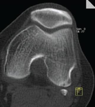 YOUNG MAN WITH LEFT KNEE PAIN FABELLA SYNDROME Arthritic changes of lateral femoral condyle