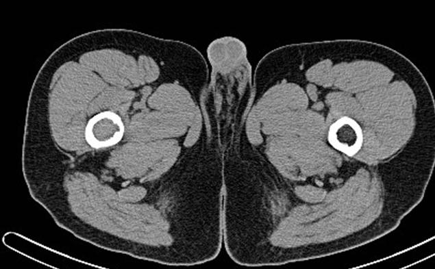 26 YO SOLDIER WITH RIGHT HIP PAIN TUMOR (EG) ENDOSTEAL