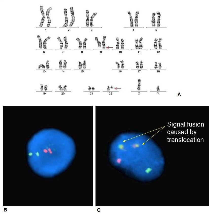 257 Figure 1. A. Karyotype 46,XY,t(9;22); B. A normal cell with two clearly separated Green (BCR probe) and Red (ABL probe) signals; C.