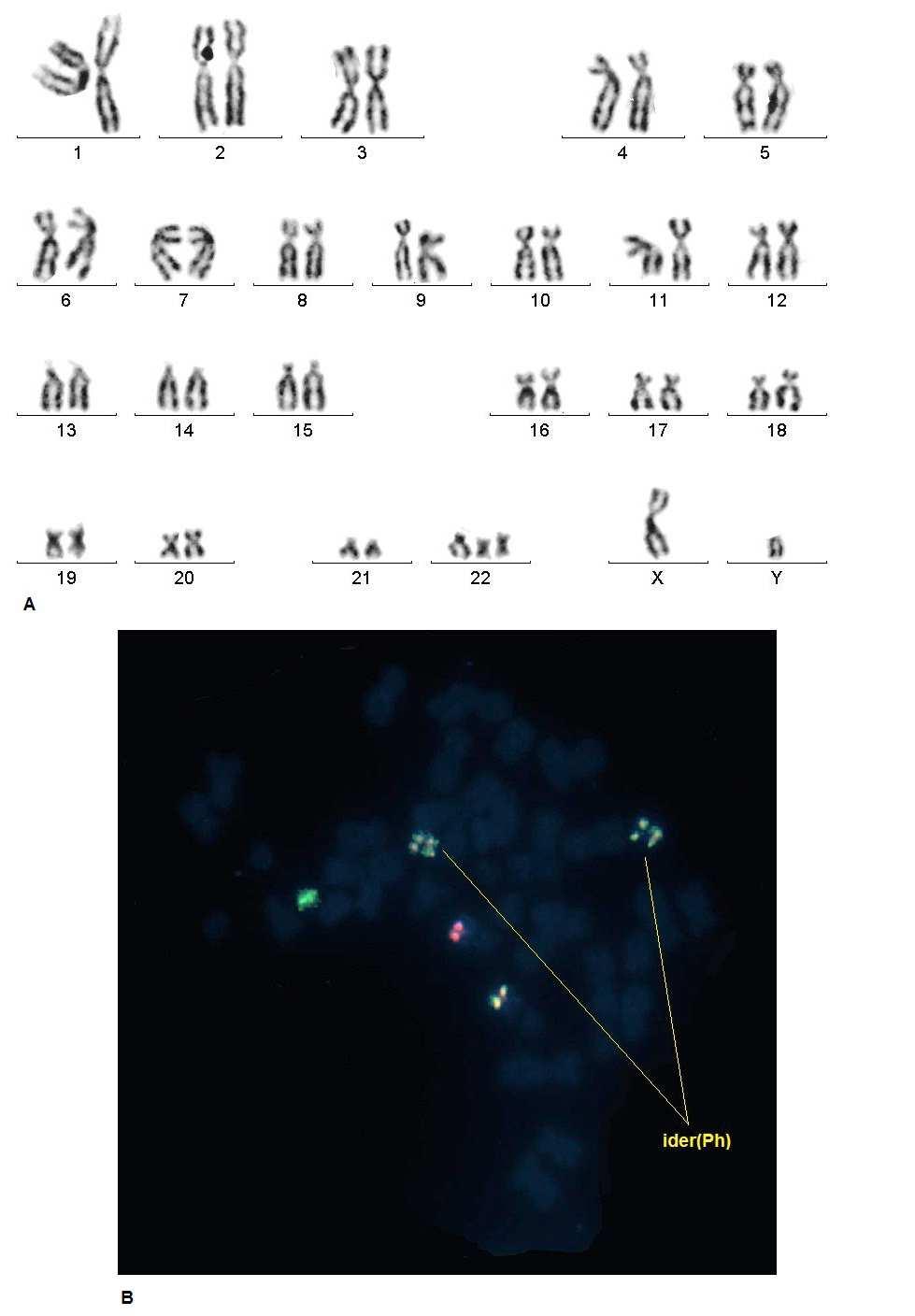 259 Figure 3. A. Karyotype 47,XY,der(9),2ider(22)t(9;22)(q34;q11) B. A cell with one Green signal (BCR probe, ch 22) and one Red (ABL probe,ch 9) signals and 5 Fusion signals. 1R1G1F.