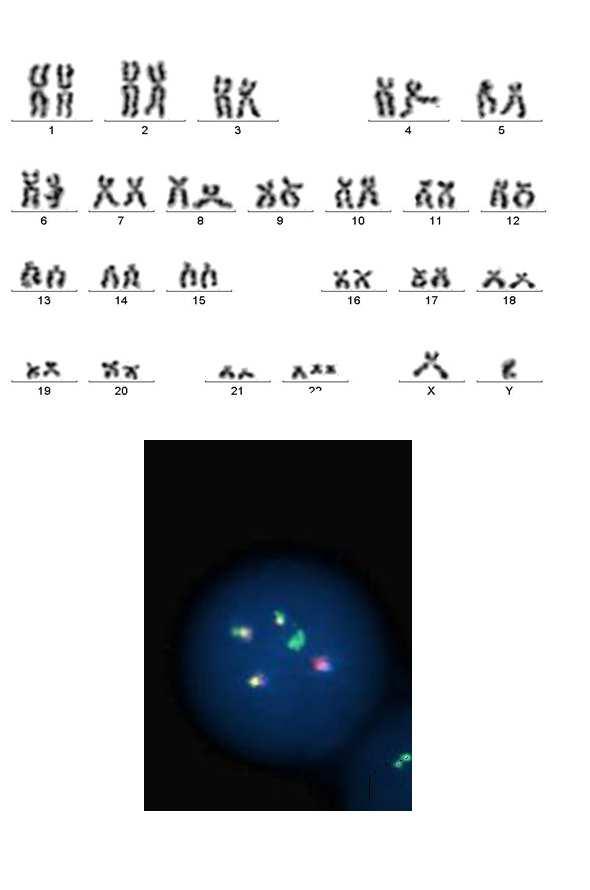 261 Figure 5. A. Karyotype 47,XY,t(9;22),+Ph; B. A cell with one Green signal (BCR probe, ch 22) and one Red (ABL probe,ch 9) signals and 3 Fusion signals.