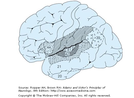 Aphasias-Motor Full Broca s involves operculum, insula and subjacent white matter with contralateral hemiparesis of face, arm Telegraphic speech