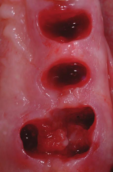 reporting on changes to both the hard and soft tissue (height and width) of the alveolar process (mm or %) after tooth extraction (up to February 2012).