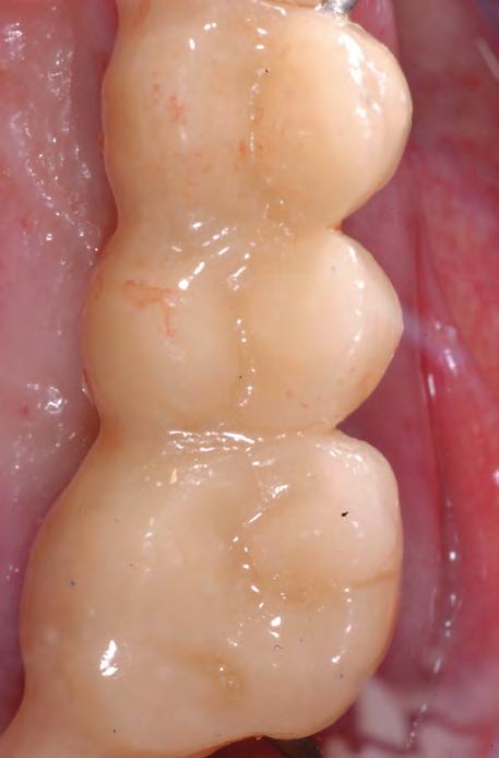 After ridge preservation has been performed, the study suggested a protocol for planning and treating such cases with guided implant surgery (Rossi et al, 2010).