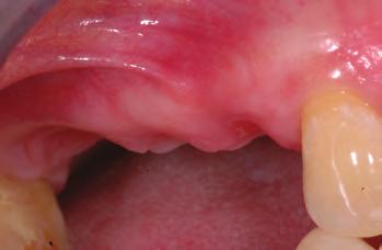 (PSR) of four in the molar areas. The area in the first quadrant was elected to be treated with extractions and simultaneous bone grafting for ridge preservation (Figure 1).