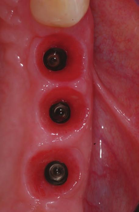 A combination of ridge preservation techniques with subsequent guided implant surgery will reduce the surgical trauma to the
