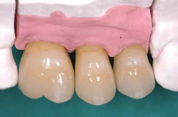 periodontitis will also help in the preservation of the primary goals.