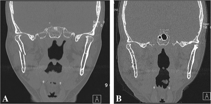 Nam et al. BMC Surgery 2013, 13:25 Page 4 of 7 Figure 2 A 48-year-old female patient with a right subcondylar fracture. A. The fragment was displaced in the medial direction with the head pointing in the lateral direction.