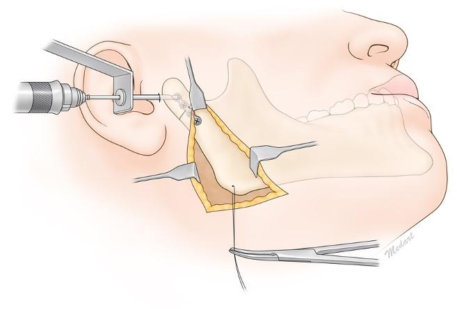 For the right condylar neck, the Risdon approach was used to expose the fracture site. After making a 0.