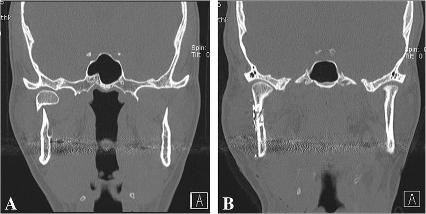 Nam et al. BMC Surgery 2013, 13:25 Page 5 of 7 Figure 4 A 33-year-old male patient with a right condylar neck fracture. A. Preoperative CT findings. B. Reduction and fixation of miniplates was performed with the use of a trochar combined with the Risdon approach.