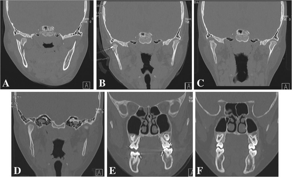Nam et al. BMC Surgery 2013, 13:25 Page 6 of 7 Figure 7 CT image of the fracture site in a pediatric patient with a condylar neck fracture. A.