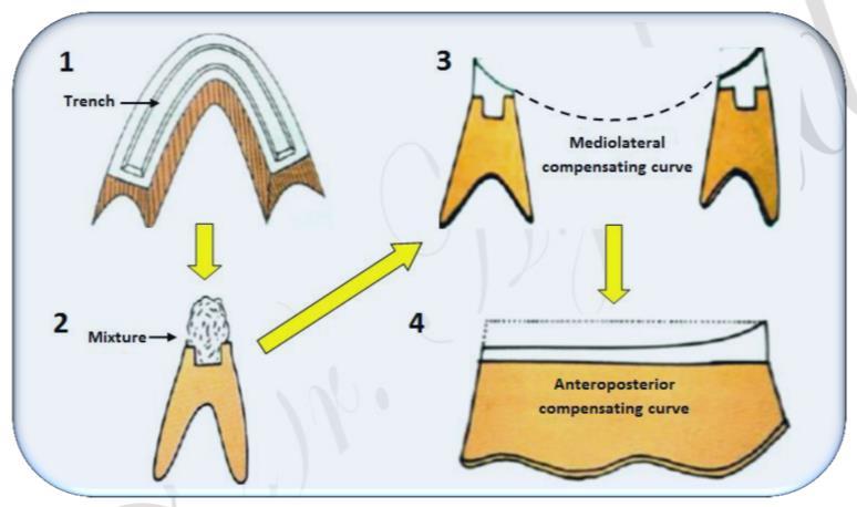 A trench is made along the length of mandibular rim. A 1:1 mixture of pumice and dental plaster is loaded into the trench.