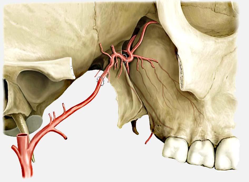 Maxillary Artery entering pterygopalatine fossa ECA