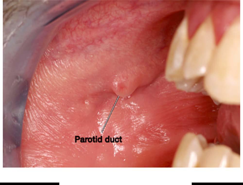 Intraoral opening of the parotid