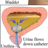 prostate enlargement) Weak bladder medications to stimulate bladder to