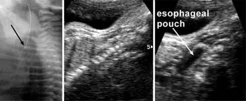 Occasionally (after 25 weeks), the dilated proximal esophageal pouch can be seen as an elongated upper mediastinal and retrocardiac anechoic