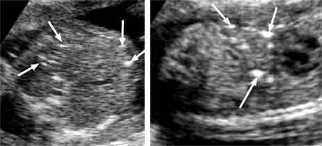 Meconium ileus and hyperechogenic fetal bowel at 16 18 weeks of gestation may be present in 75% of fetuses with cystic fibrosis.