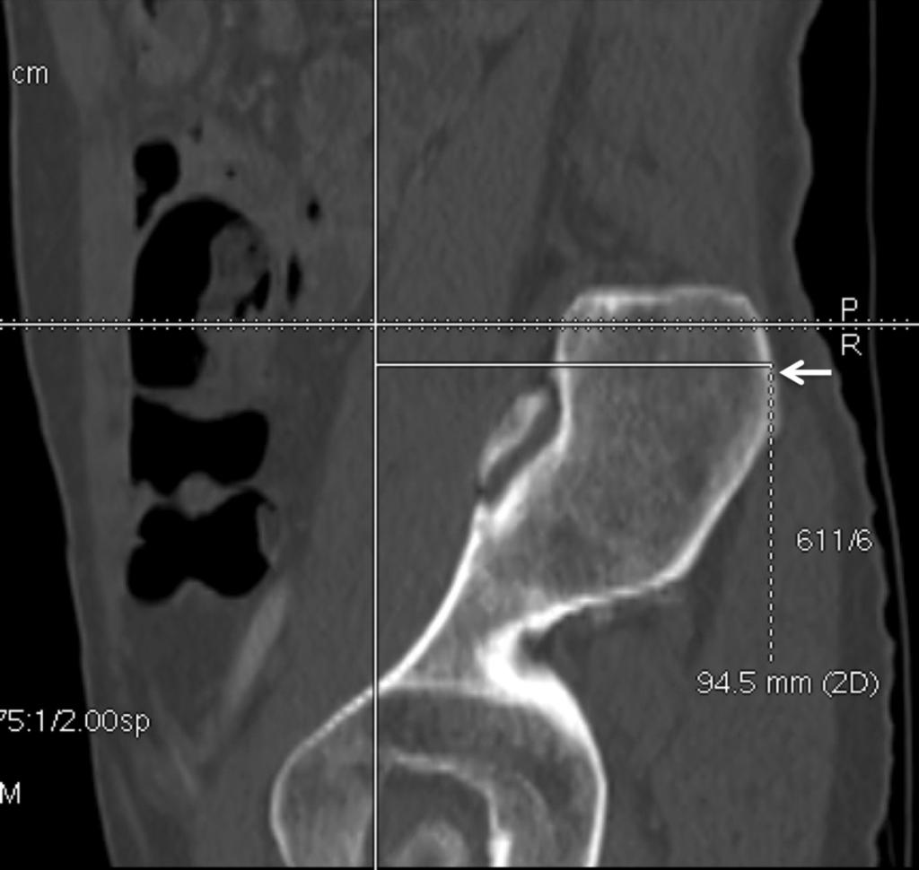 Fig. 7: Sagittal reformat showing measurement from the PSIS (arrow) to the