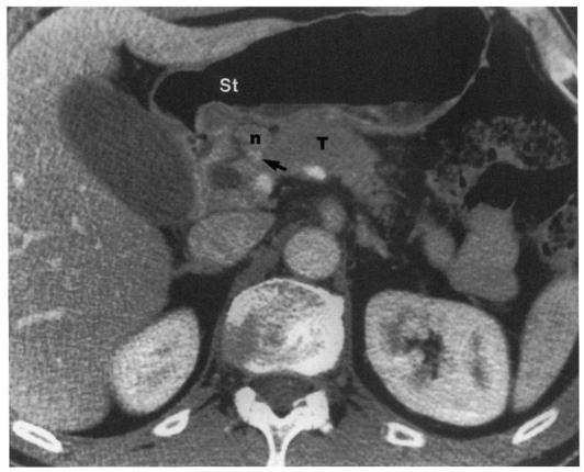 Pancreatic ductal adenocarcinoma involving body and cephalad portion of head of pancreas. Note node (n) anterior to the gastroduodenal artery (arrow) and behind the gastric antrum (St).