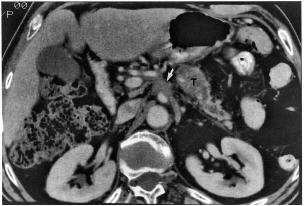 (a) Large tumor (T) from body of pancreas with invasion of the posterior wall of stomach (St) and encasement of the splenic artery (arrow), (b) CT 4 cm caudal to a shows multiple tumor deposits