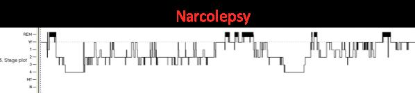 sleep paralysis is common Narcolepsy 1/3 don't have cataplexy