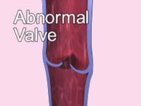 Varicose Veins Low pressure capacitance leg vessels Damaged valves Affect blood