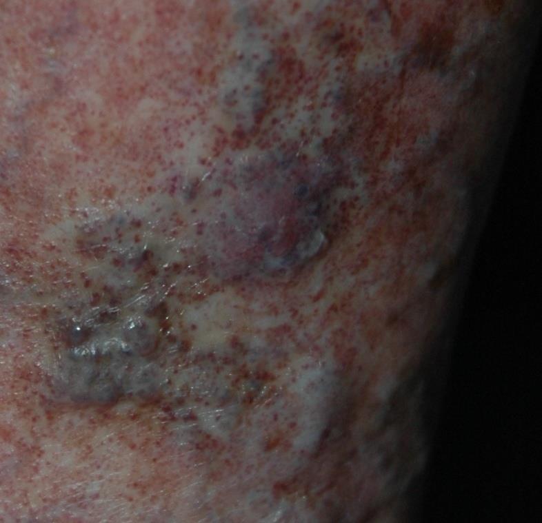 L- term Complications of VVS Varicose eczema Thrombophlebitis