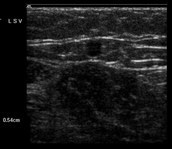 Ultrasound Guided Sclerotherapy (UGS) Injection