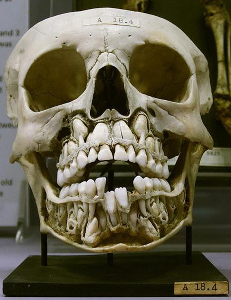 Skull of a 7 year old child Bones of the upper & lower jaw have been