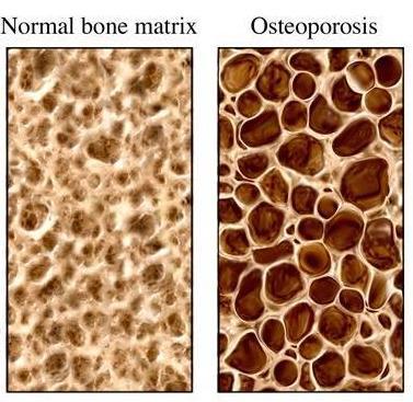 loss of bone mass