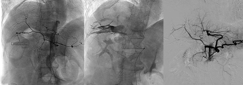 A B C Fig. 4. Transarterial angiogram via celiac artery.