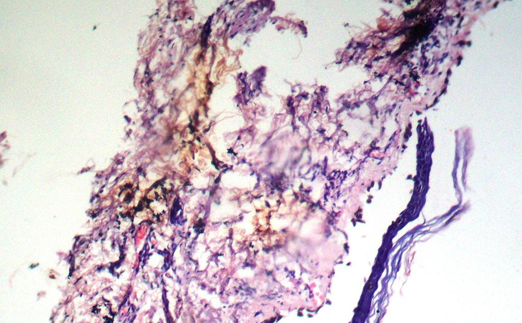 Vora et al. Figure 1. Vulgaris- 10X showing suprabasal cleft. (H&E stain) of alcohol and then stained by haematoxylin and eosin. Multiple serial sections of the biopies were studied.