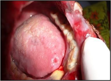 In our study the lesions are seen commonly effecting buccal mucosa followed by lips and palate.