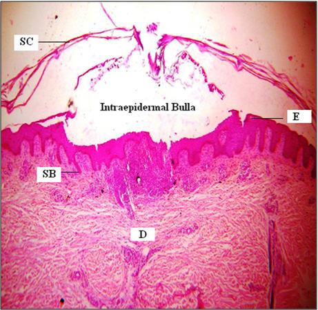 D, Dermis Figure 2 Pemphigus Foliaceus with Intraepidermal Bulla (Bulla