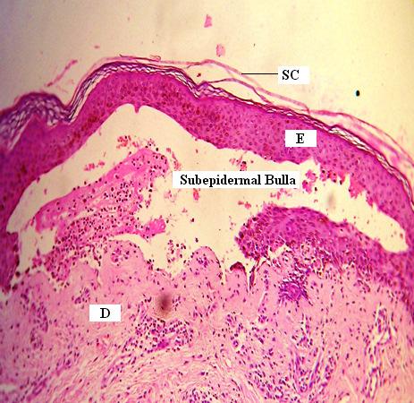 Basale; D, Dermis Figure 3 Bullous Pemphigoid with Subepidermal Bulla