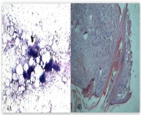 and metastatic deposits from renal cell carcinoma, histopathological correlation was not available. One case of benign spindle cell lesion was diagnosed as neurofibroma on histopathology.