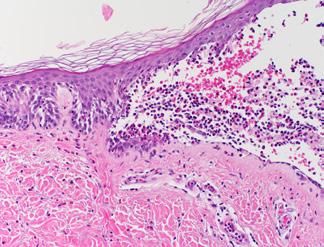 Enlargement and/or rupture of pustules and vesicles in the right axilla of the women with pemphigus vulgaris.