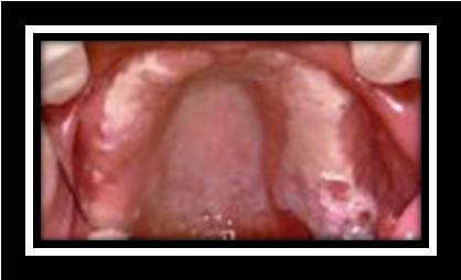 Other Burning mouth syndrome Lichen planus Recurrent aphthous stomatitis (most commonly, minor aphthae) Head and neck radiation *Rare.