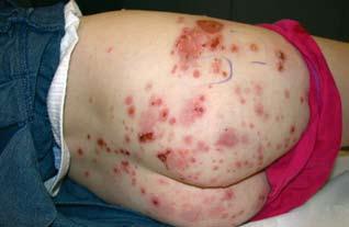 Blistering skin conditions THEME Bullous Bullous (BP) is a chronic, autoimmune, subepidermal, blistering skin disease that rarely involves the mucous membranes.