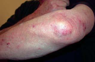 Blistering skin conditions THEME Porphyria cutanea tarda Porphyria cutanea tarda encompasses a group of disorders in which activity of the haem synthetic enzyme uroporphyrinogen decarboxylase is