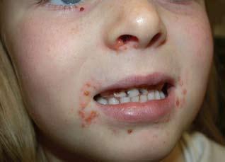 10 Porphyria cutanea tarda is the most common porphyria and includes familial and acquired types that may occur in individuals with a genetic predisposition (sporadic porphyria cutanea tarda), after