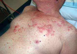 Bullous impetigo Figure 7. Bullous with blisters and urticarial patches Some patients are heterozygote for haemochromatosis.