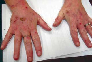 theme Blistering skin conditions Figure 8. This type of skin fragility and poor healing can be seen in both epidermolysis bullous acquisita (pictured) and porphyria cutanea tarda 10. Porphyria.